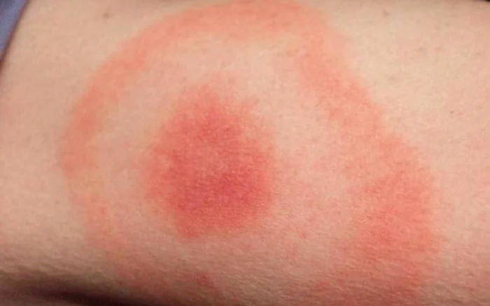 aspetto del morso di zecca