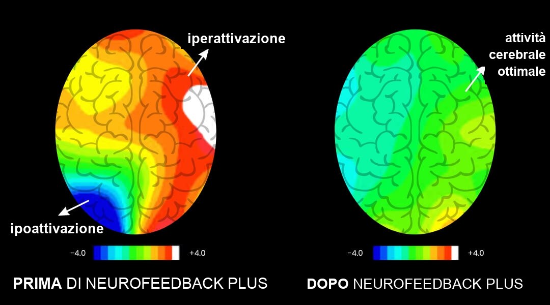 Attività cerebrale prima e dopo l'allenamento cerebrale