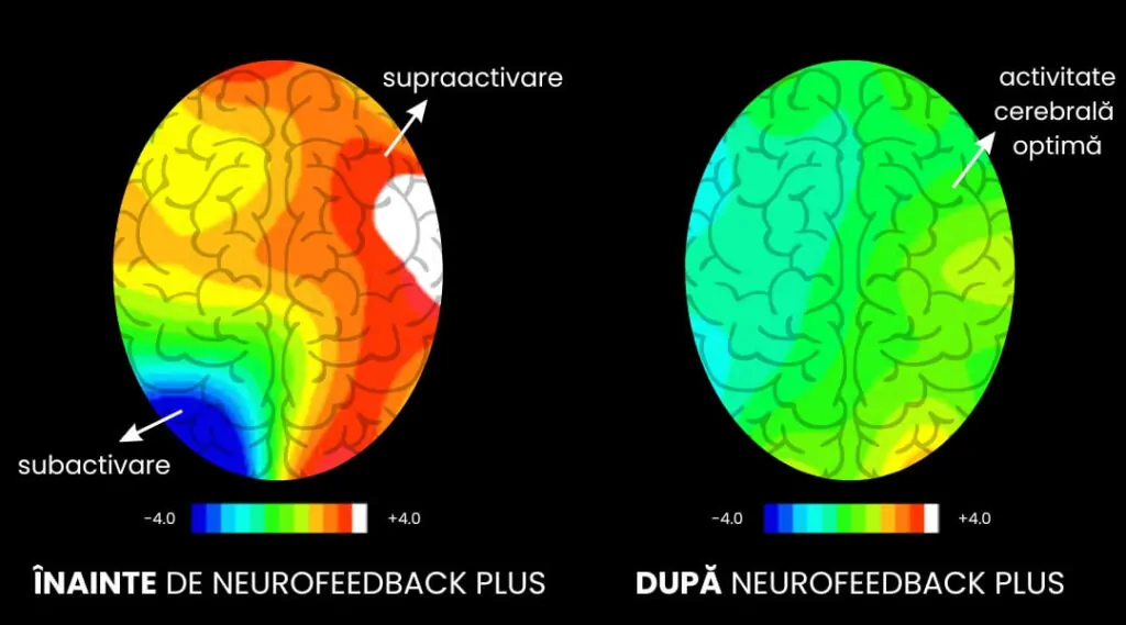 Inainte si dupa NeuroFeedback Plus