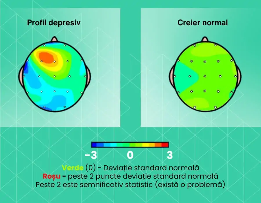 Depressione